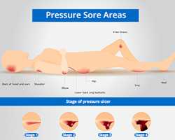 Pressure Ulcer Staging and Prevention Guide