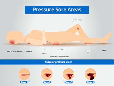 Pressure ulcer stages picture