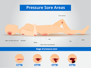 Gel Mattress Overlays Prevent Pressure Ulcers and Bed Sores