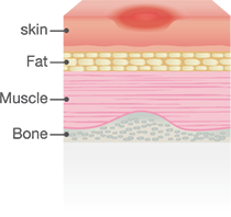 stage one pressure ulcer picture