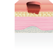 stage three pressure ulcer picture