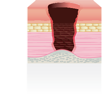 stage four pressure ulcer picture