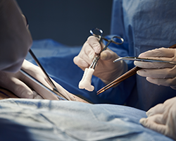 Surgical sponges are the most common retained foreign bodies