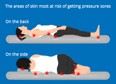 The areas of skin most at risk of getting sore depends on lying down or sitting.