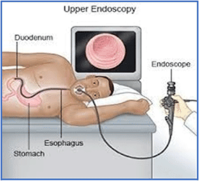 Upper endoscopy foreign object removal device.