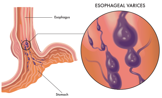 Close up diagram of esophageal varices.
