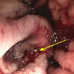 Bleeding peptic ulcer seen during an endoscopy procedure.