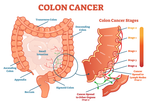 rectal polypectomy