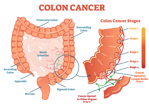 Colon cancer: image of colon and cancer stages