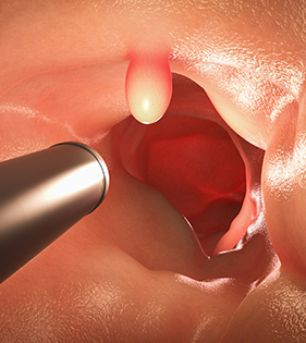 Discovering a polyp during a colonoscopy