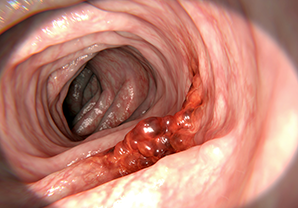 rectal polypectomy