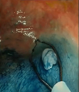 Polyp Removal