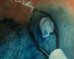 Polyp removal