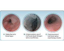 truFreeze Spray Cryotherapy for Barrett’s Esophagus
