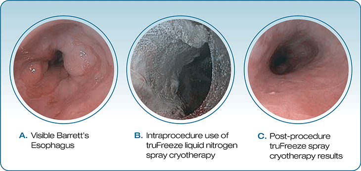 truFreeze Spray Cryotherapy for Barrett’s Esophagus