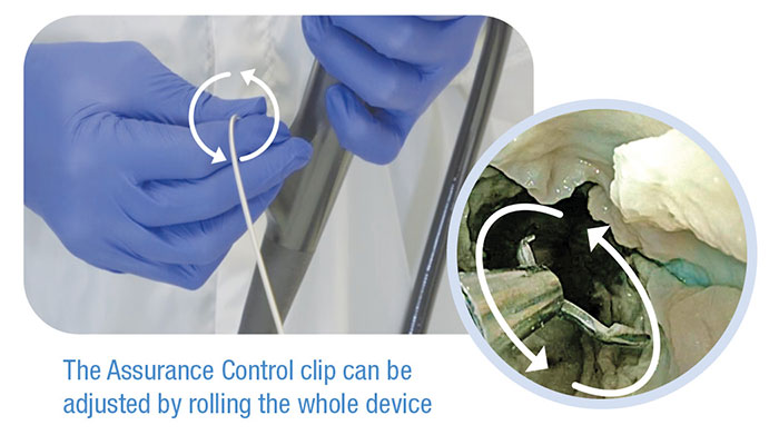 The Assurance Control clip can be adjusted by rolling the whole device